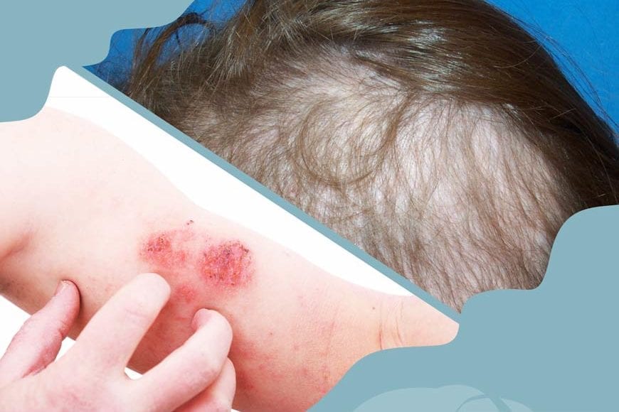 Informasjonsbrosjyre om Trichotilomani – hårnapping- og hudplukkingsslidelse